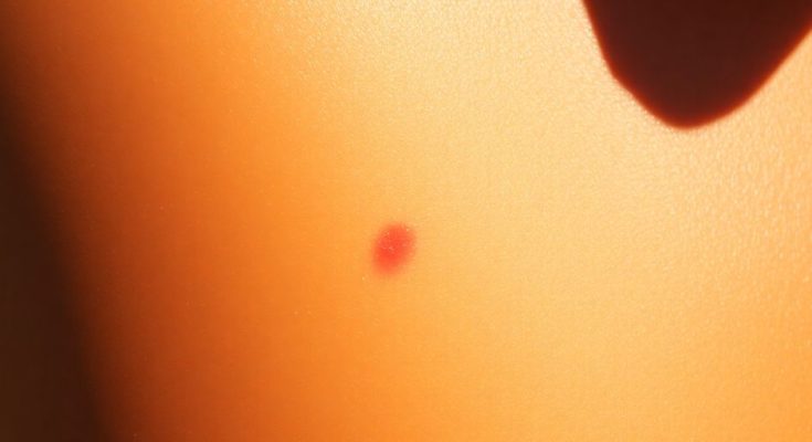 Soleil sur la peau bronzée, attention aux coups de soleil.