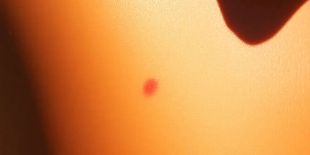 Soleil sur la peau bronzée, attention aux coups de soleil.